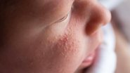 Diferença entre acne neonatal e brotoeja. - Henadzi Pechan / istock