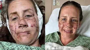 Mulher ficou gravemente ferida no rosto após ser atacada por lontra - Foto: Reprodução/Redes sociais