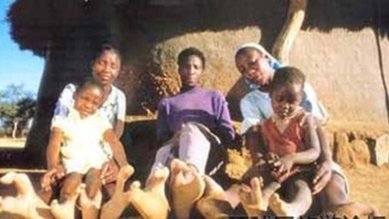Condição está presente em cerca de uma em cada quatro crianças nascidas na tribo Doma - Foto: Reprodução/Creative Commons