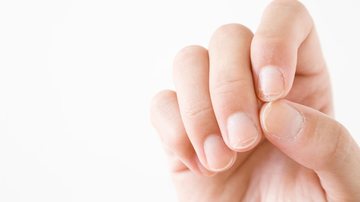 Entender as causas pode ajudar você a evitar o aparecimento dessas manchas brancas nas suas unhas. - (Imagem: FotoDuets / iStock)
