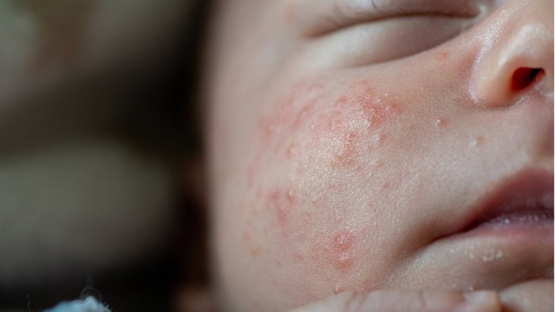 Confira o que é acne neonatal e a forma correta de lidar e tratar. - Diego Cerro Jimenez / istock