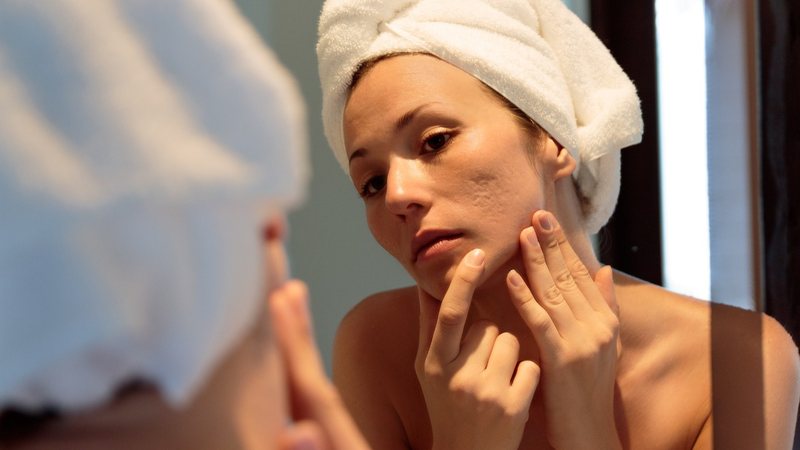 Existem diversos tipos de acne e formas diferentes de tratar. - NDStock / istock