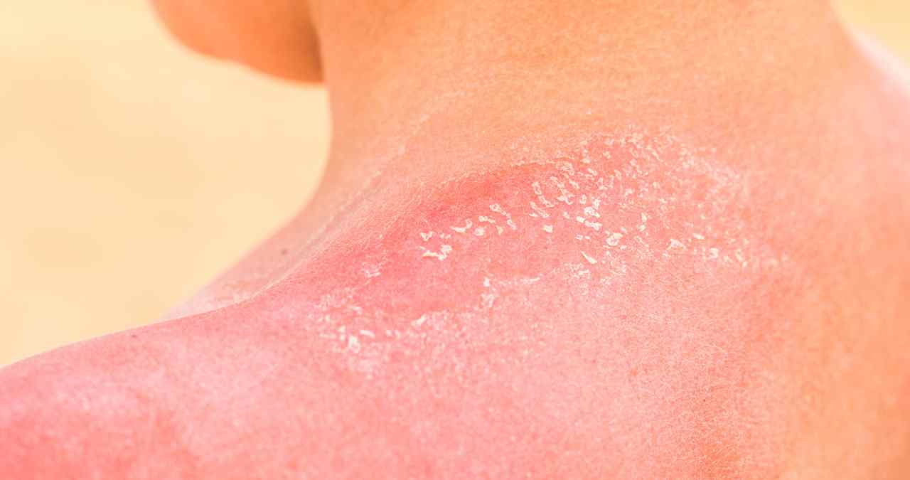 um ombro apresentado sintomas de queimadura solar