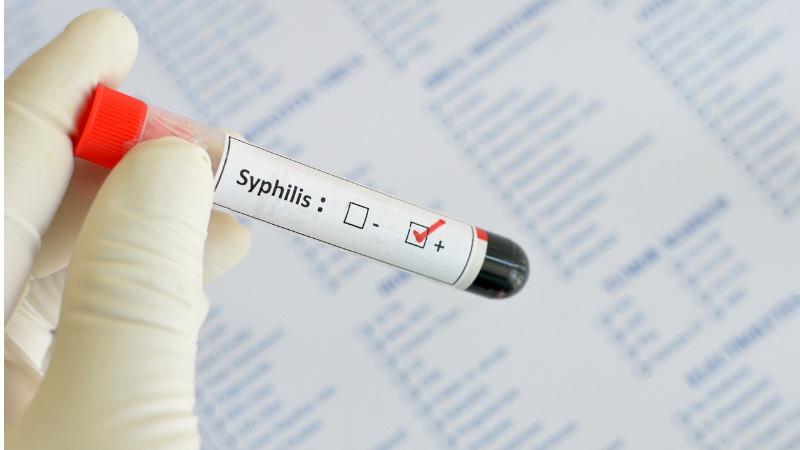 sifilis doenca transmitida pelo beijo