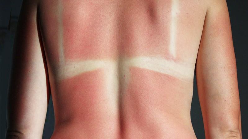 A queimadura de sol pode causar muitos problemas graves, como o câncer de pele (Foto: alexmak72427/iStock)