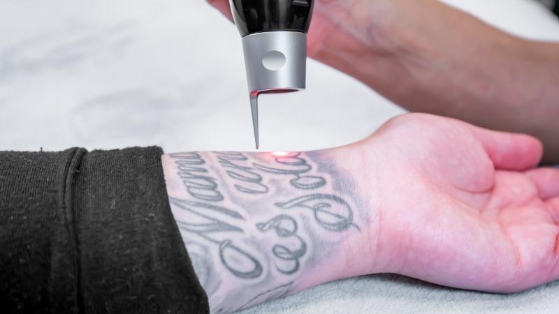 remocao tatuagem