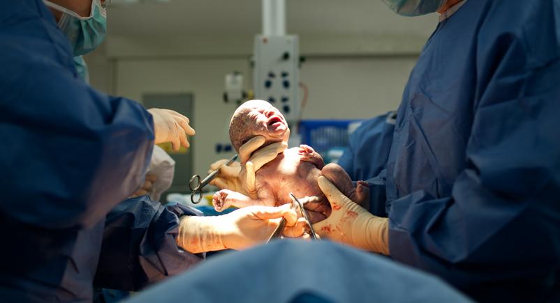 bebe nascendo atraves de cesariana