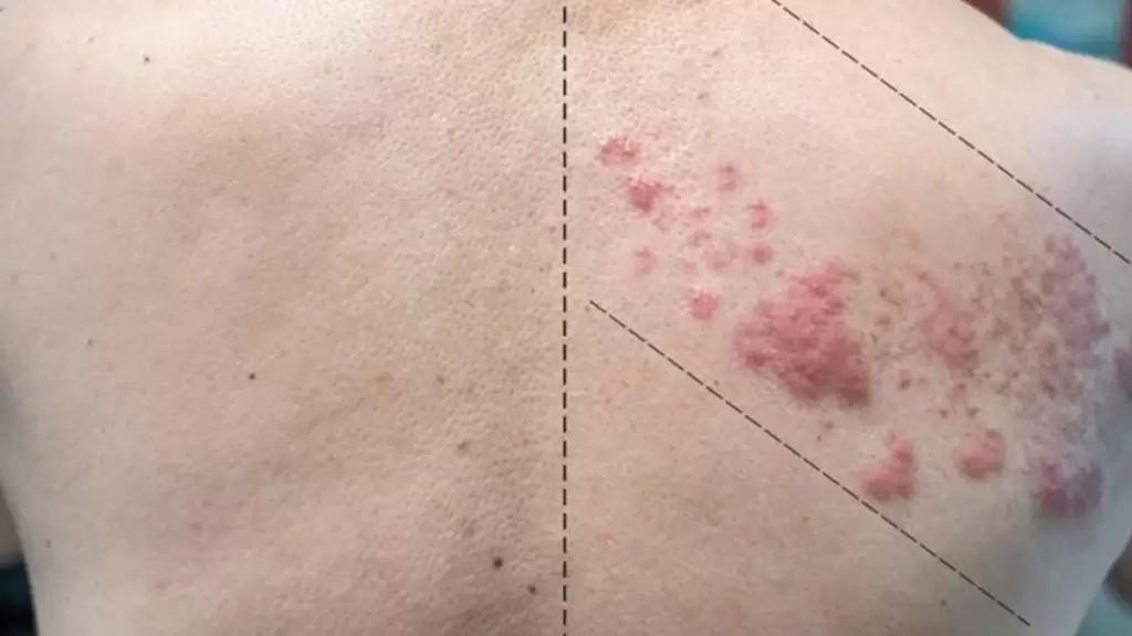 erupção na pele de uma pessoa com herpes-zóster