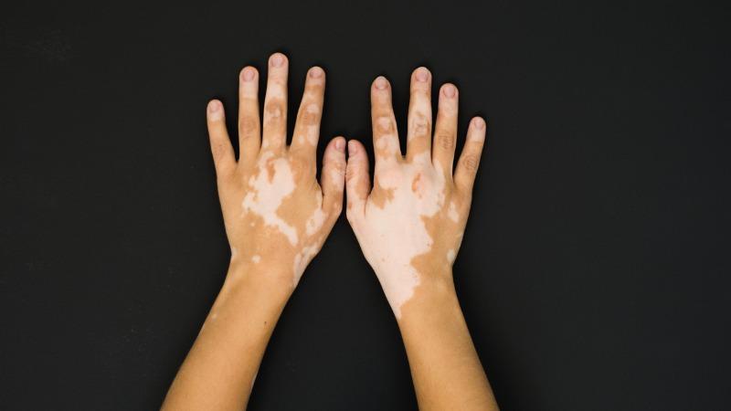 causas do vitiligo