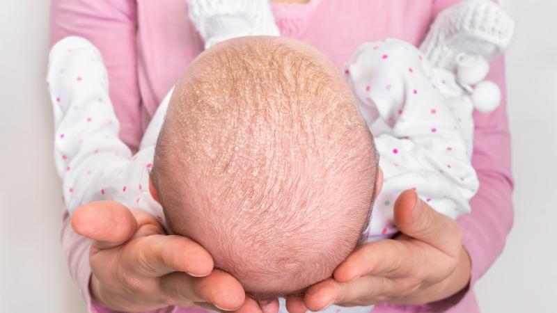 dermatite seborreica em recem nascidos crosta lactea