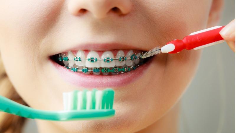 dicas higiene aparelho ortodontico