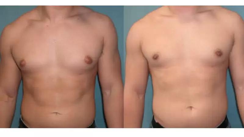 antes e depois da ginecomastia