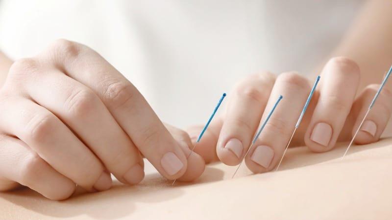 Conheça os beneficios da acupuntura e adote essa tecnica