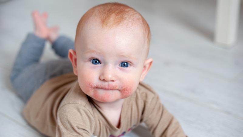 Bebê com dermatite atópica nas bochechas