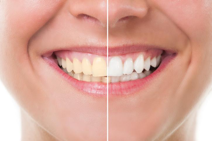 dentista faz clareamento dental, saúde bucal